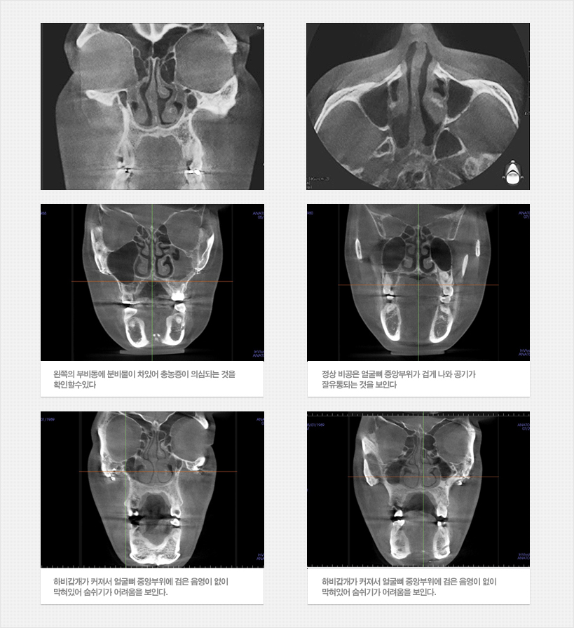 코속 3D CT 영상